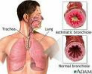 Asthma