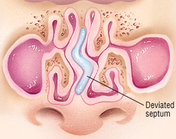 Deviated nasal septum