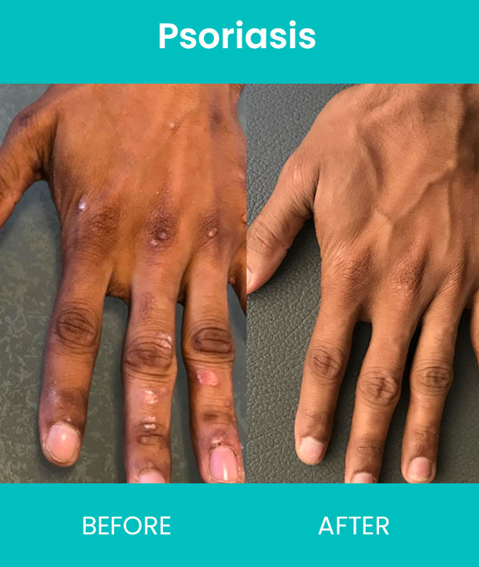 Psoriasis Treatments