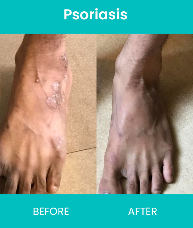 Psoriasis Treatments