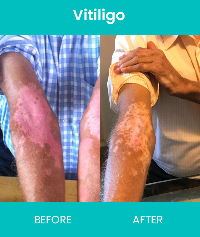 Vitiligo Treatments