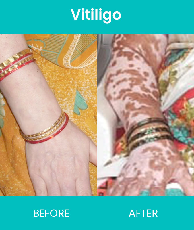 Vitiligo Treatments